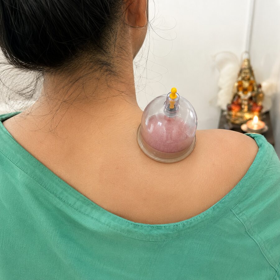 Cupping therapy