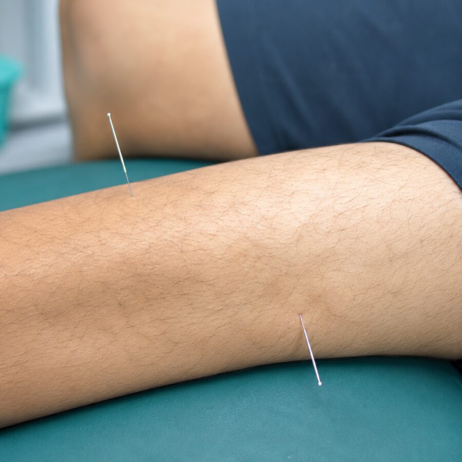 Dry needling therapy